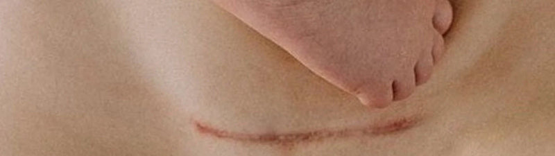 Accouchement vaginal après césarienne : qu’en disent les études ?